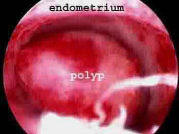 Uterine polyp during hysteroscopy