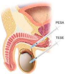 Image result for Surgical Sperm Retrieval
