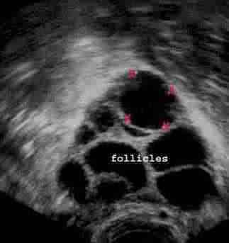 Ultrasound scan showing multiple follicles