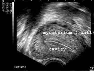 Ultrasound scan of the uterus