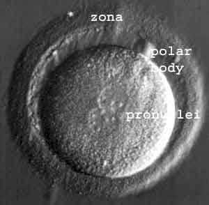 IVF - Part 2 - More about Test Tube Babies. Egg retrieval ...