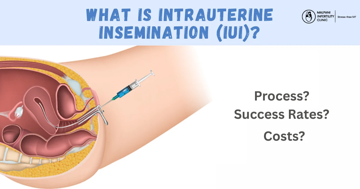 Medical illustration showing the process of intrauterine insemination (IUI), where washed sperm is inserted directly into the uterus using a thin catheter. The image highlights the concept of IUI treatment, including its process, success rates, and costs.