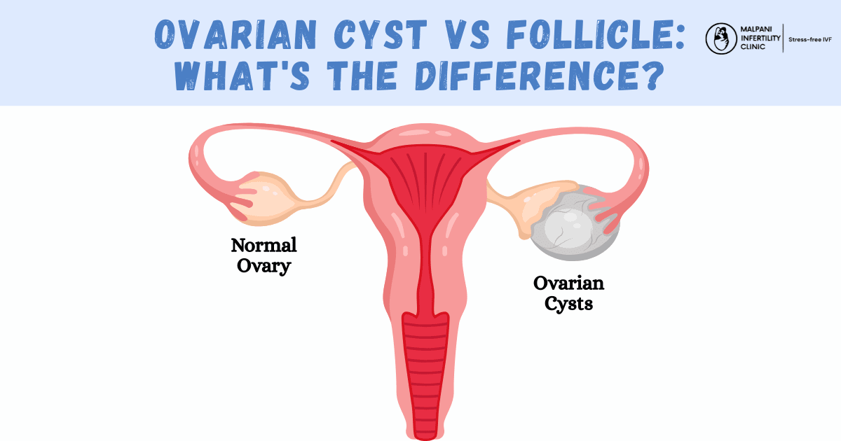 Medical illustration comparing a normal ovary with ovarian cysts.