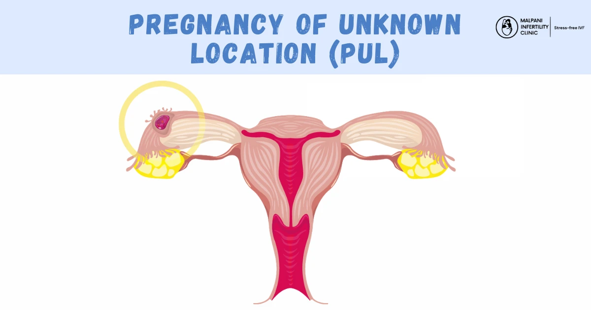 Medical illustration of the female reproductive system highlighting a pregnancy of unknown location (PUL). The image shows the uterus, ovaries, and fallopian tubes, with a highlighted area to indicate abnormal pregnancy implantation.