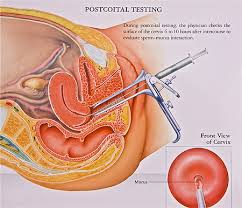 Image result for Sperm DNA fragmentation assessment