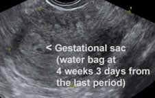 4 weeks 3 days ultrasound 18 Weeks