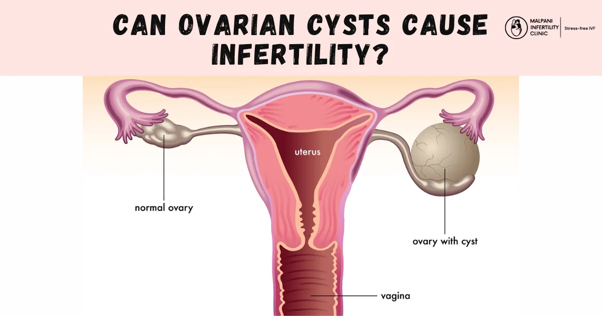 Medical illustration comparing a normal ovary and an ovary with cysts. The image shows the uterus, fallopian tubes, and vagina, highlighting how cysts can appear on the ovary and potentially affect fertility.