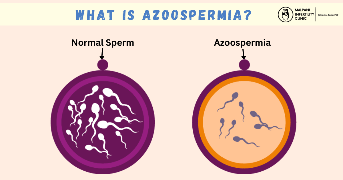 Infographic comparing normal sperm with azoospermia. The left circle shows healthy sperm cells, while the right circle shows very few or absent sperm, representing azoospermia, a condition causing male infertility.