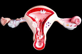 Image result for Adenomyosis and Infertility