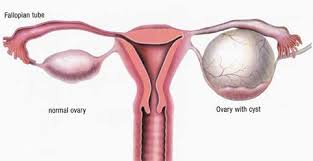 Image result for Ovarian Cysts