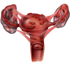 Image result for Endometriosis