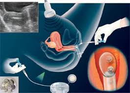 Image result for blastocyst transfer