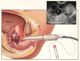 Image result for IVF Procedure with Donor Egg