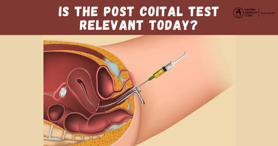 Illustration showing the process of a post-coital test, where a healthcare provider collects a cervical mucus sample using a syringe-like instrument after intercourse to evaluate sperm survival and motility inside the cervix. The image highlights the traditional diagnostic method once used to assess fertility in couples.