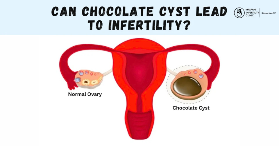 Medical illustration showing a comparison between a normal ovary and an ovary affected by a chocolate cyst (endometrioma). The image highlights how a cyst filled with old, dark blood can distort the ovary and potentially affect ovulation or fertility.