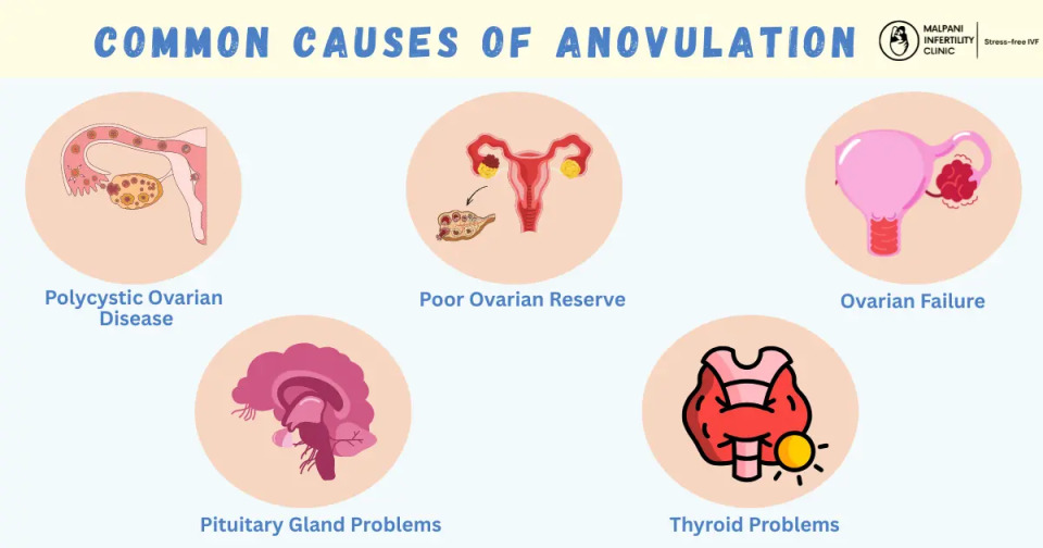 An infographic illustration listing common causes of anovulation including PCOD, ovarian failure, and hormonal imbalances. each accompanied by a relevant anatomical diagram.